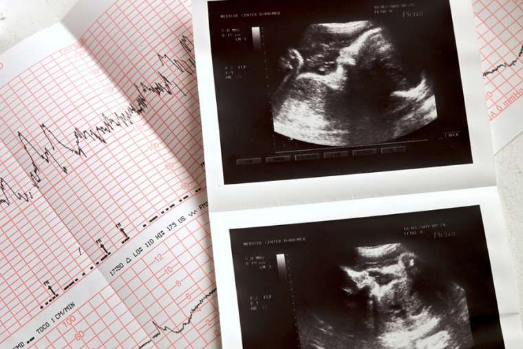Studija: Stopa plodnosti u Teksasu porasla nakon ‘Heartbeat Act’